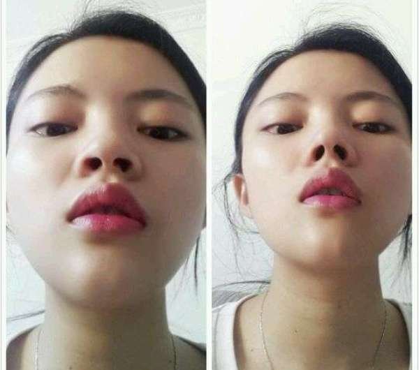 Chinese Women Warned Against Using "Nose Cushions" to Make Their